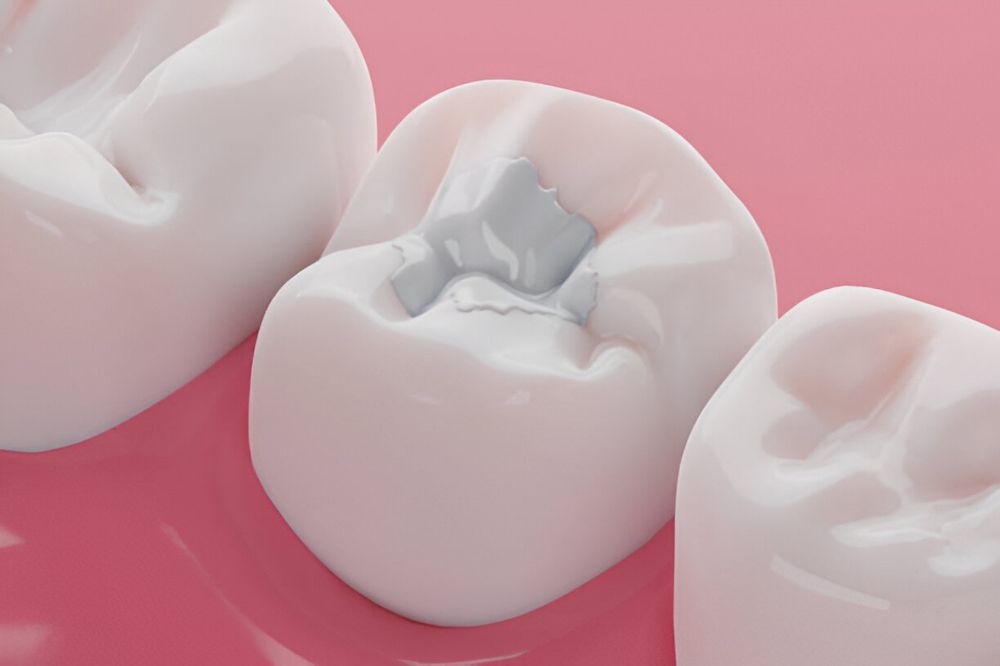 dental filling in Saskatoon