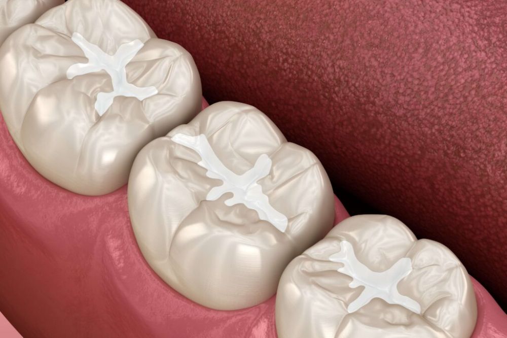 cosmetic tooth fillings