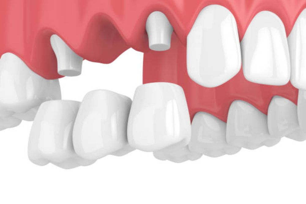 Dental Bridges in Saskatoon