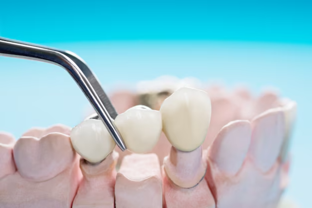dental crowns in Saskatoon